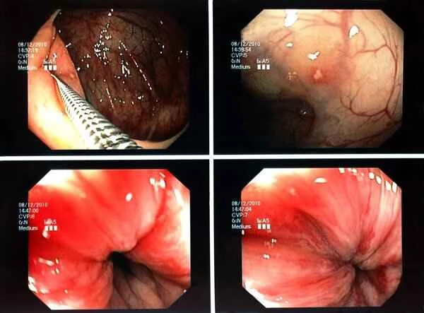 Is surgery for redundant sigmoid colon painful?