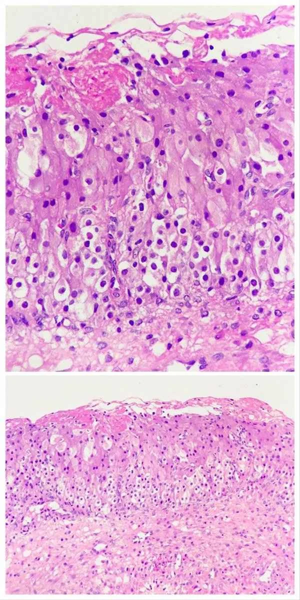 What is a villous adenoma of the intestine?