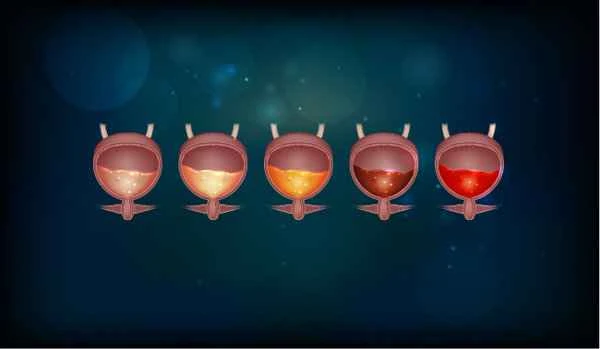 Does a bowel tumor cause difficulty urinating?