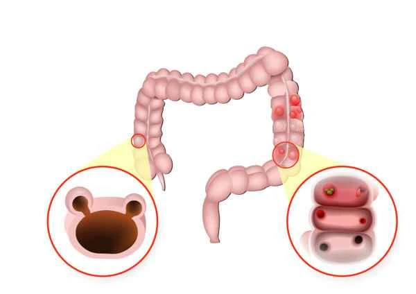 What are the symptoms of intestinal adhesions after a cesarean section?