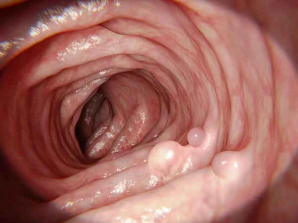 Does intestinal polyp cause anal heat?