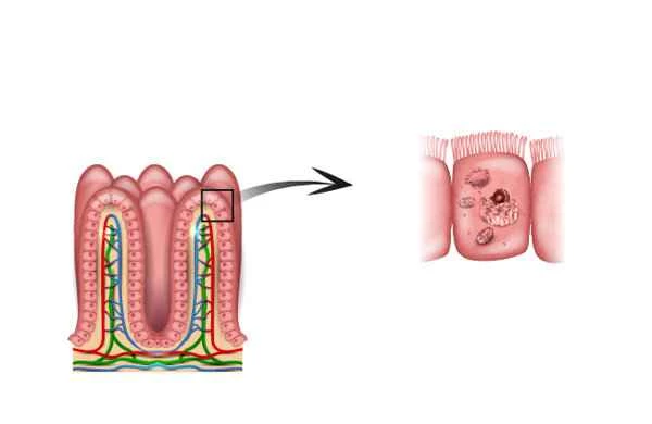 How to detect polyps in the intestines
