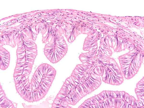 What is a gastrointestinal stromal tumor?