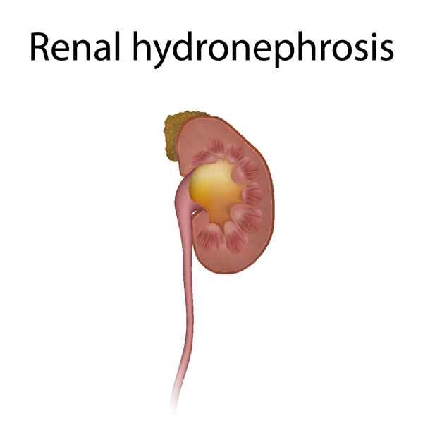 Is hydronephrosis a serious condition caused by chemotherapy for stomach cancer?