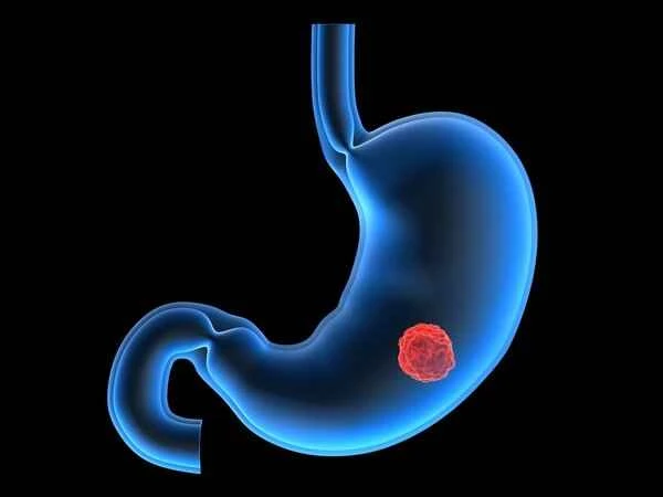 Is hydronephrosis a serious condition caused by chemotherapy for stomach cancer?