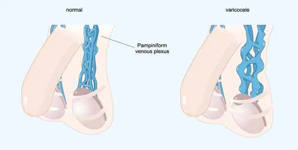Are sigmoid colon leiomyomas benign?