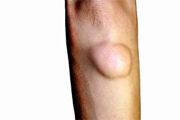 What does intestinal polyp mean?