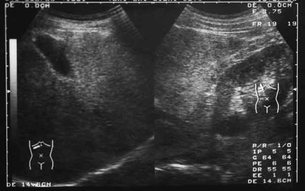 What causes upper abdominal intestinal obstruction?