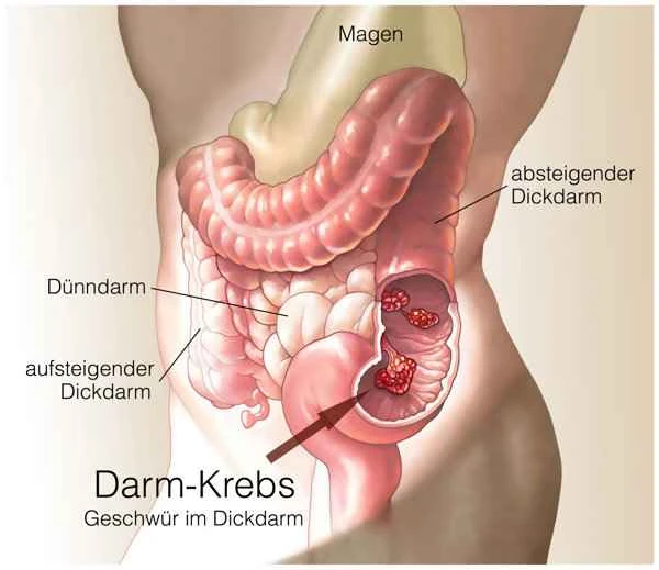 Does a bowel tumor cause difficulty urinating?