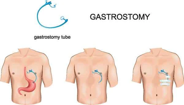 Stoma care precautions