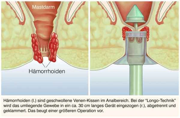 Is small bowel obstruction easy to treat?