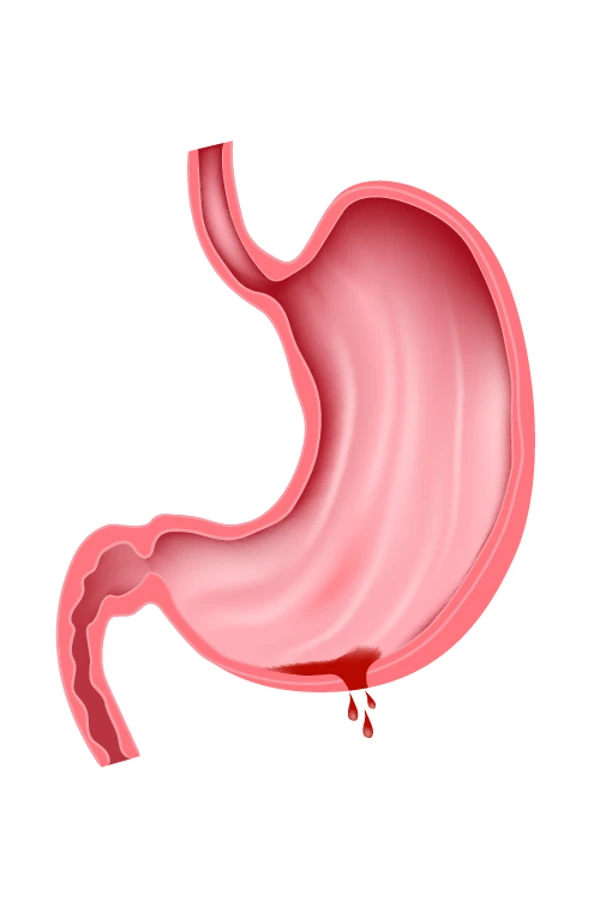 Is postoperative gastrointestinal bleeding due to improper procedure?