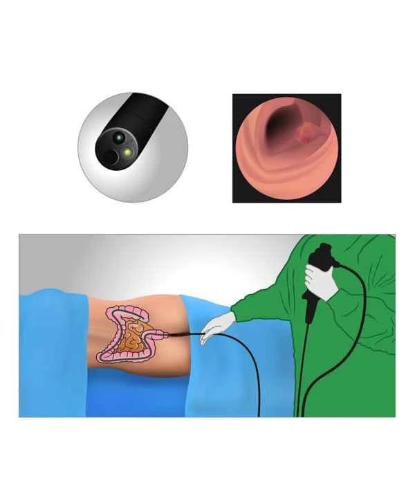 Can intestinal polyps grow to the anus?