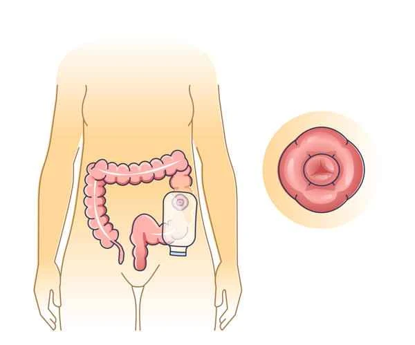 What are the possible long-term effects of enterocutaneous fistula surgery?