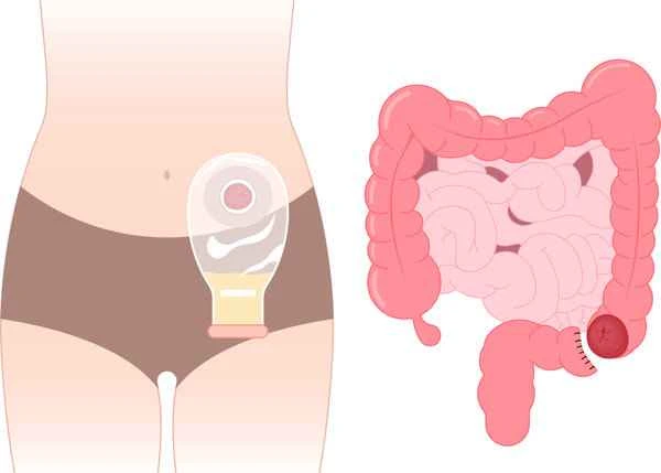 Can I drink fish soup after having intestinal polyps surgery?