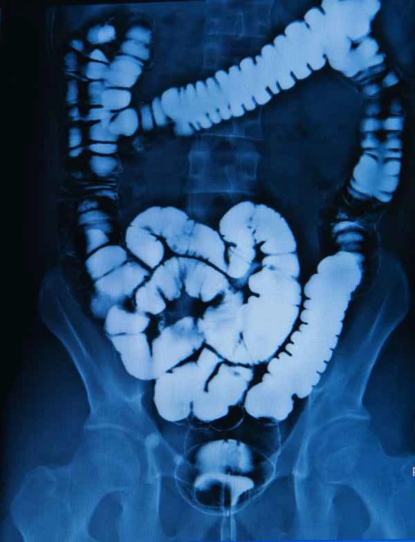 Does duodenal obstruction require resection?