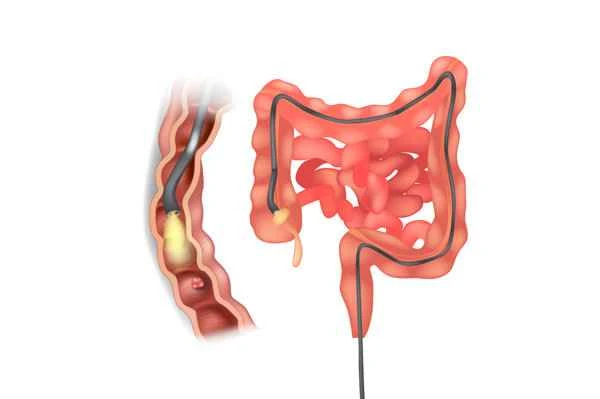 What does EMR mean for colon polyps?