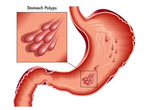 What are the symptoms and manifestations of gastric polyps?