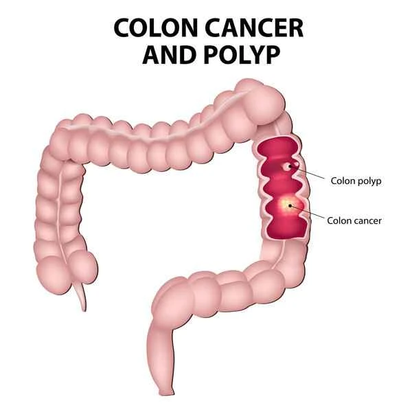 At what size should a colonoscopy polyp be required for a biopsy?
