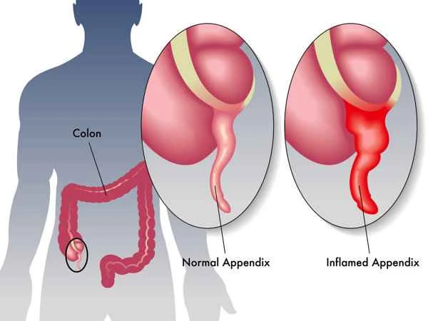 What to do if you get an infection after appendectomy?