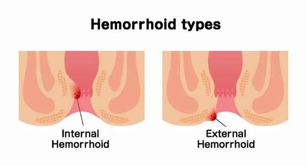 Can intestinal polyps grow to the anus?