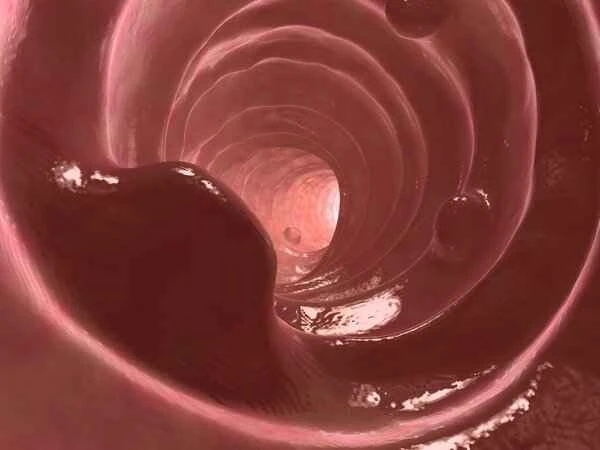 What does EMR mean for colon polyps?