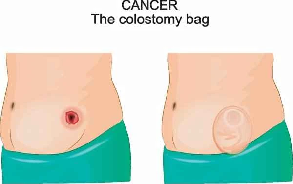 Stoma care precautions