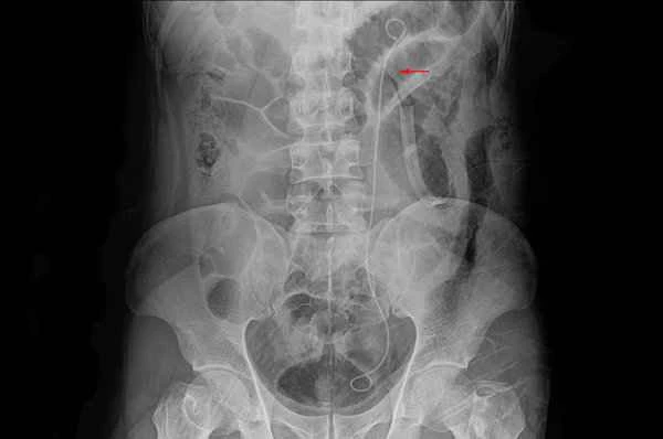 Harmful effects of titanium clips left in the intestines