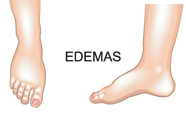 What do malignant intestinal polyps look like?