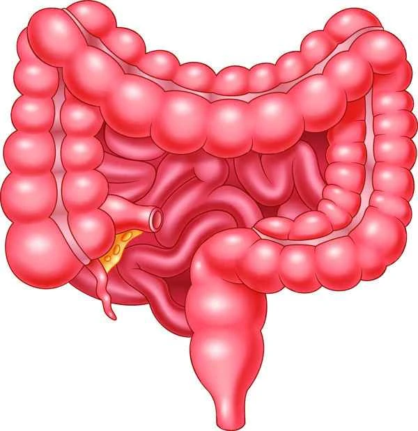 Intestinal obstruction with multiple narrowings in the small intestine