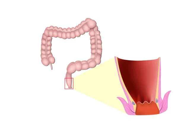 Does intestinal bloating occur after treatment for intestinal obstruction?