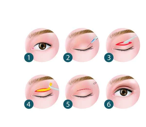 How long does it take to recover after colonoscopy to remove polyps?