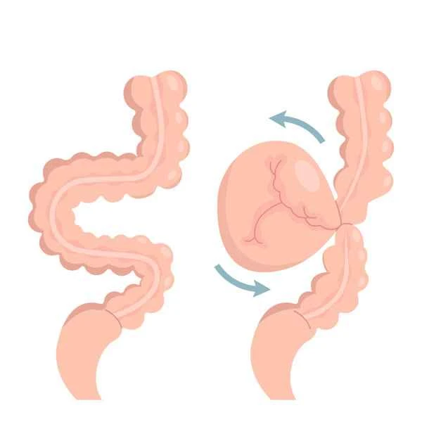 How to cure intestinal obstruction without surgery?
